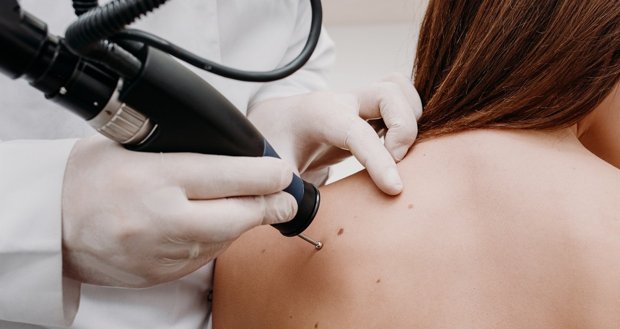 viral warts